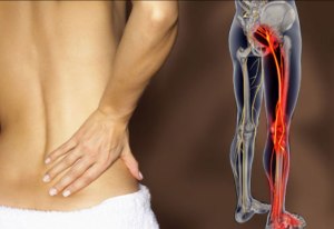 sciatica